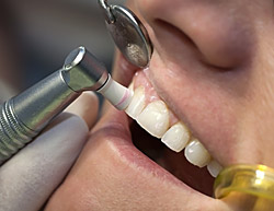 Teeth Cleaning & Whitening